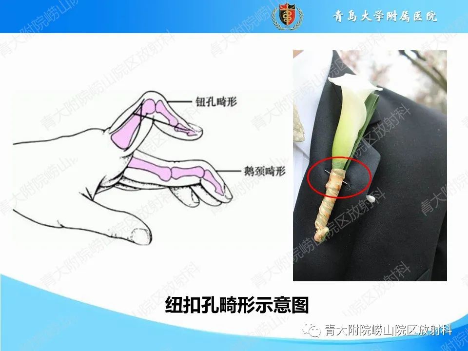 影像PPT - 【PPT】纽扣孔畸形-8