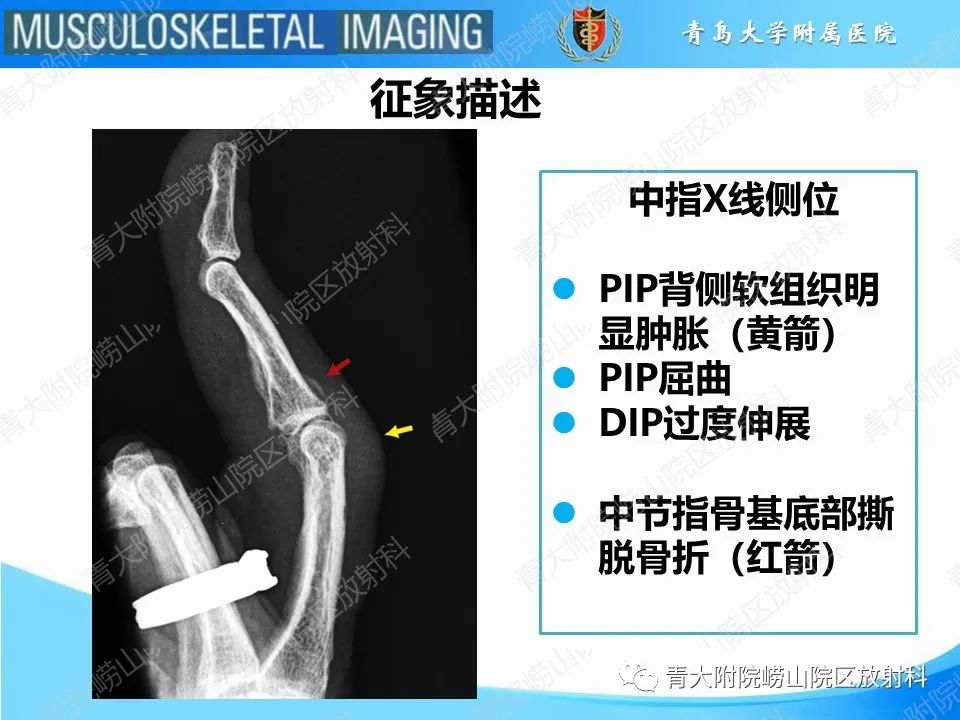 影像PPT - 【PPT】纽扣孔畸形-17
