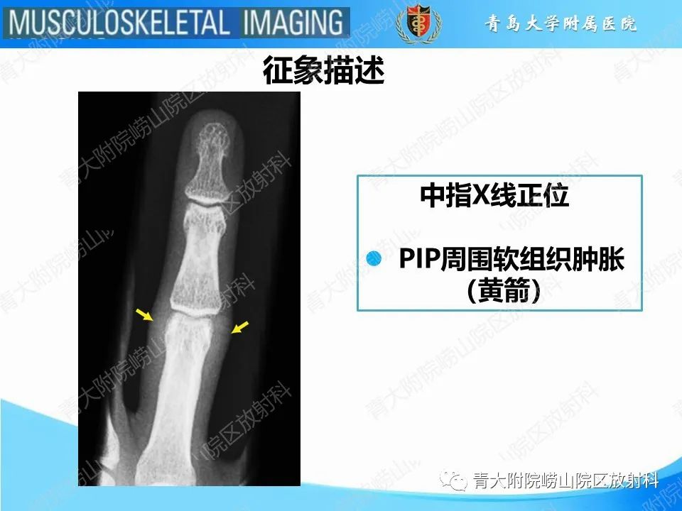 影像PPT - 【PPT】纽扣孔畸形-18