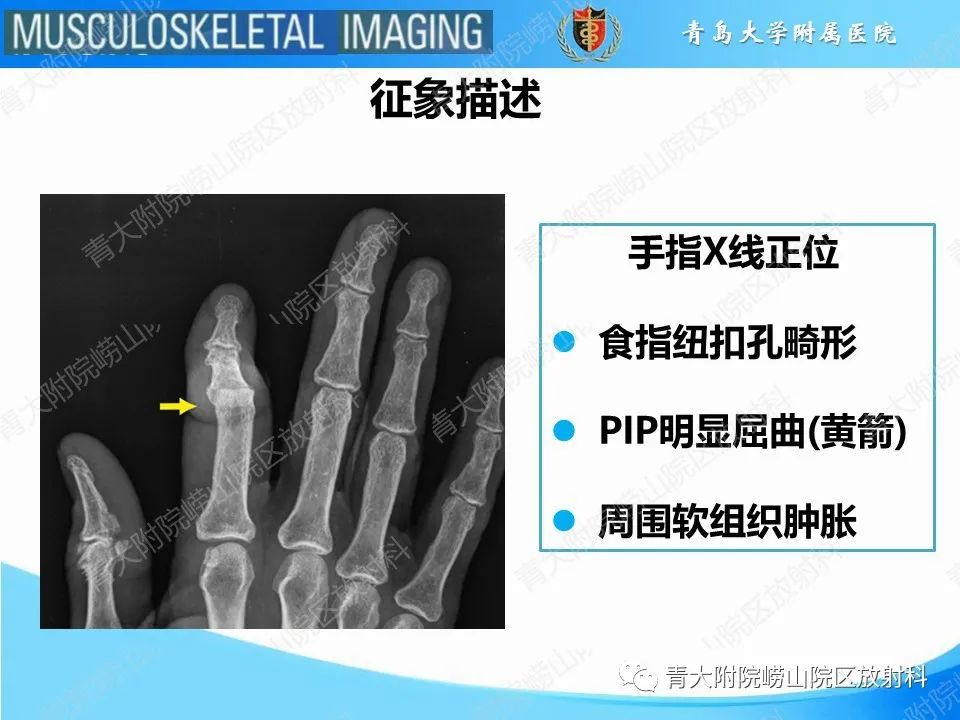 影像PPT - 【PPT】纽扣孔畸形-19