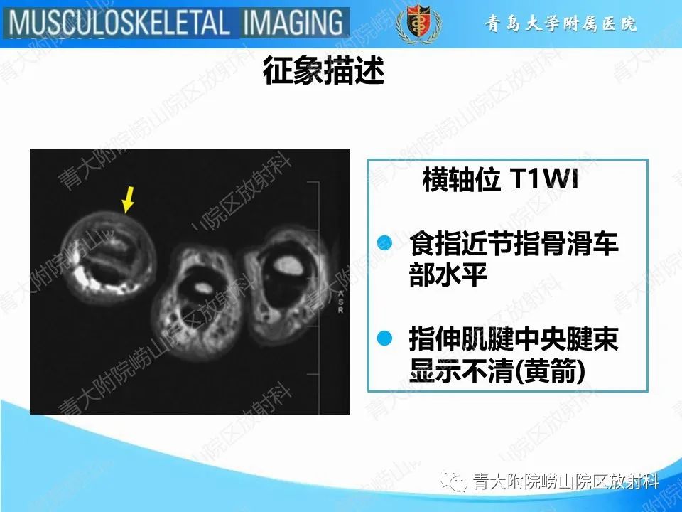 影像PPT - 【PPT】纽扣孔畸形-20