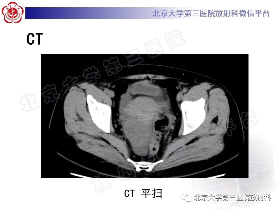 影像PPT - 【PPT】卵巢纤维卵泡膜细胞瘤-3