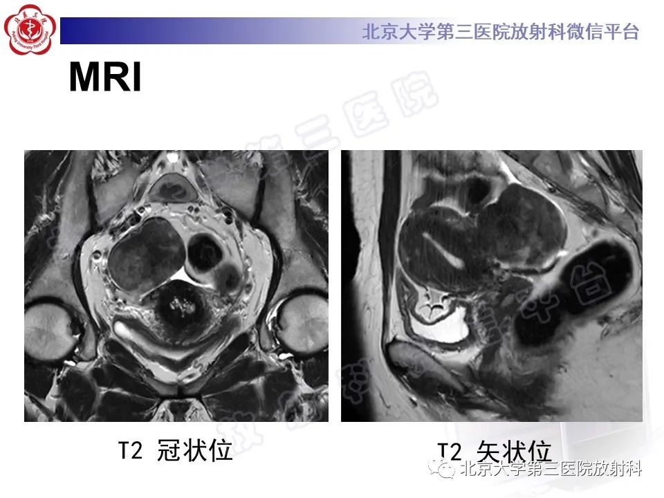 影像PPT - 【PPT】卵巢纤维卵泡膜细胞瘤-6