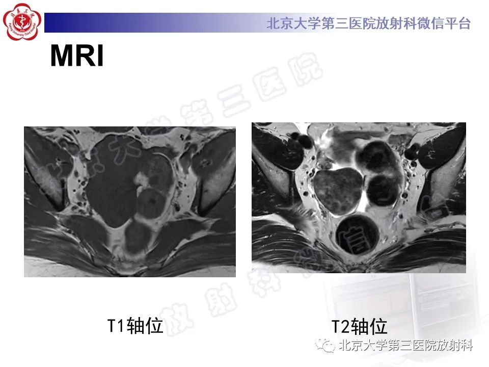 影像PPT - 【PPT】卵巢纤维卵泡膜细胞瘤-5