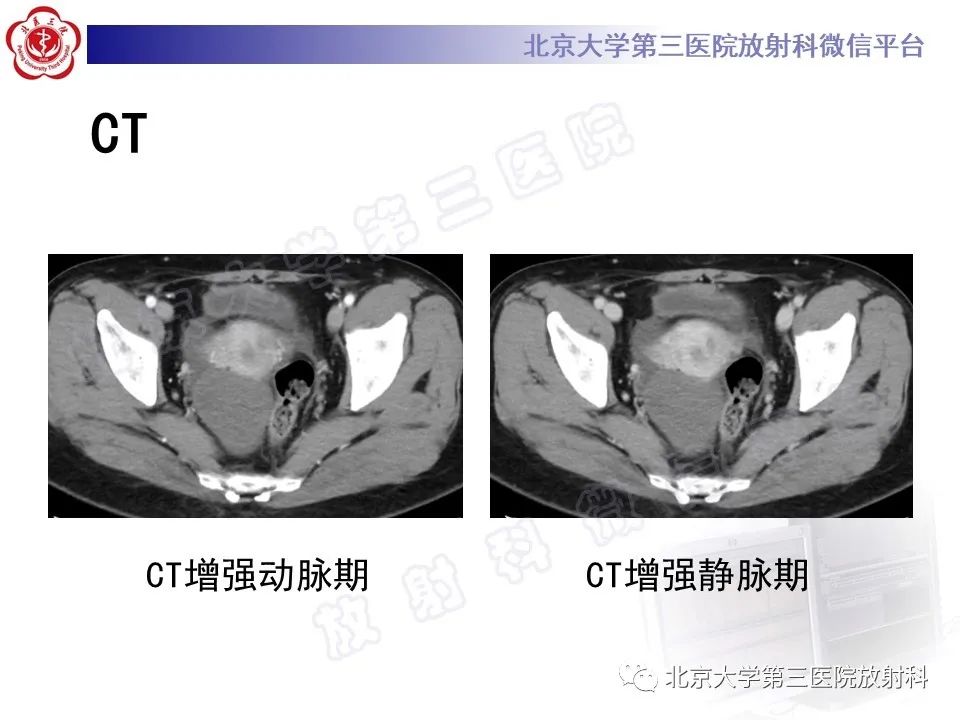 影像PPT - 【PPT】卵巢纤维卵泡膜细胞瘤-4