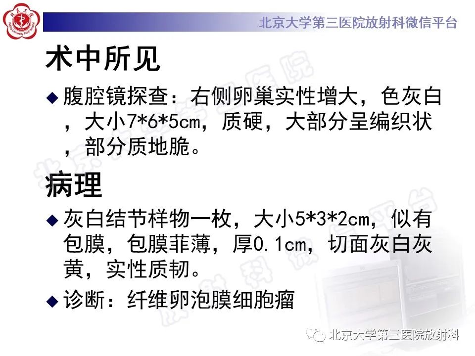 影像PPT - 【PPT】卵巢纤维卵泡膜细胞瘤-9
