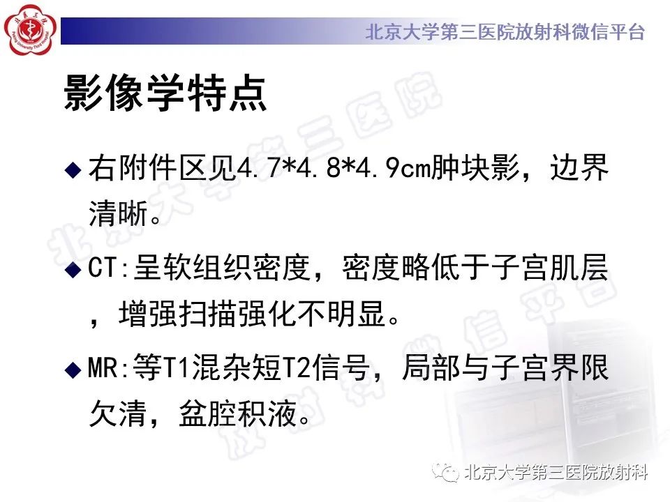 影像PPT - 【PPT】卵巢纤维卵泡膜细胞瘤-7