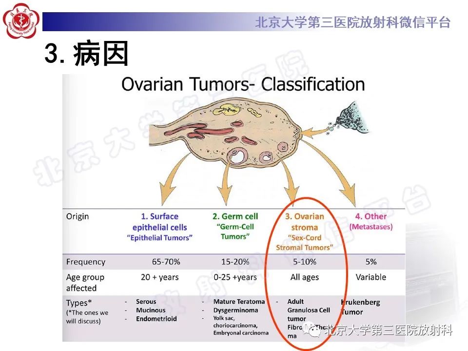 影像PPT - 【PPT】卵巢纤维卵泡膜细胞瘤-13