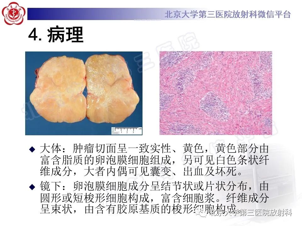 影像PPT - 【PPT】卵巢纤维卵泡膜细胞瘤-15