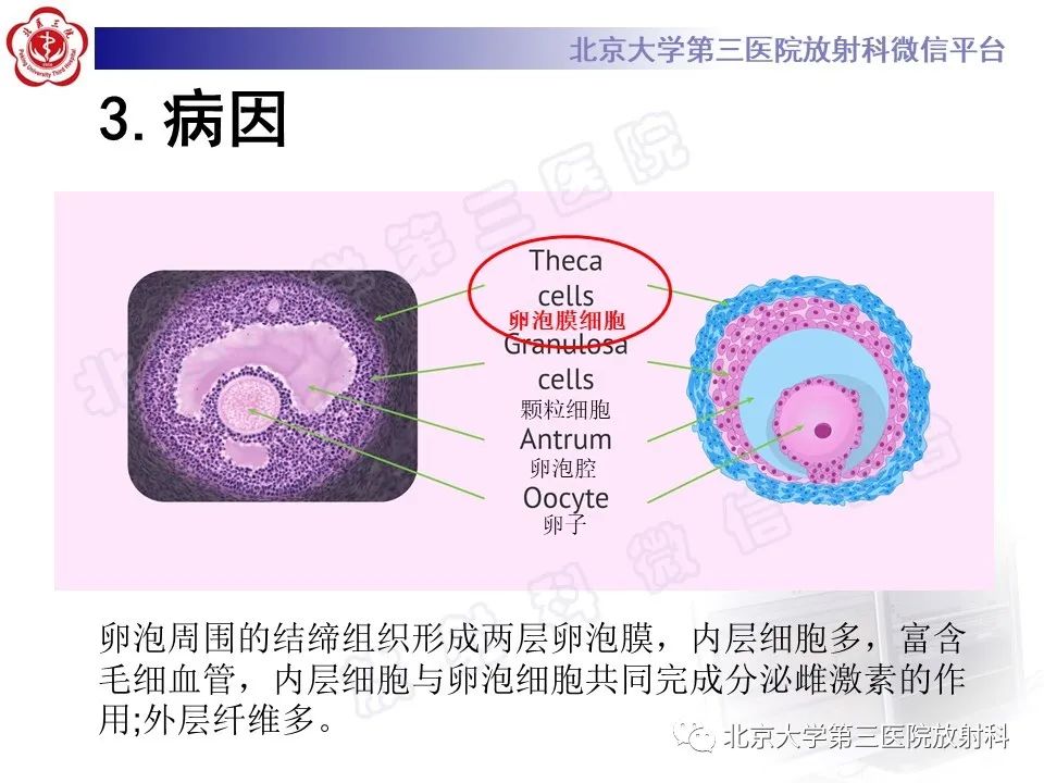 影像PPT - 【PPT】卵巢纤维卵泡膜细胞瘤-14