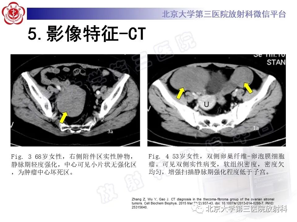 影像PPT - 【PPT】卵巢纤维卵泡膜细胞瘤-18
