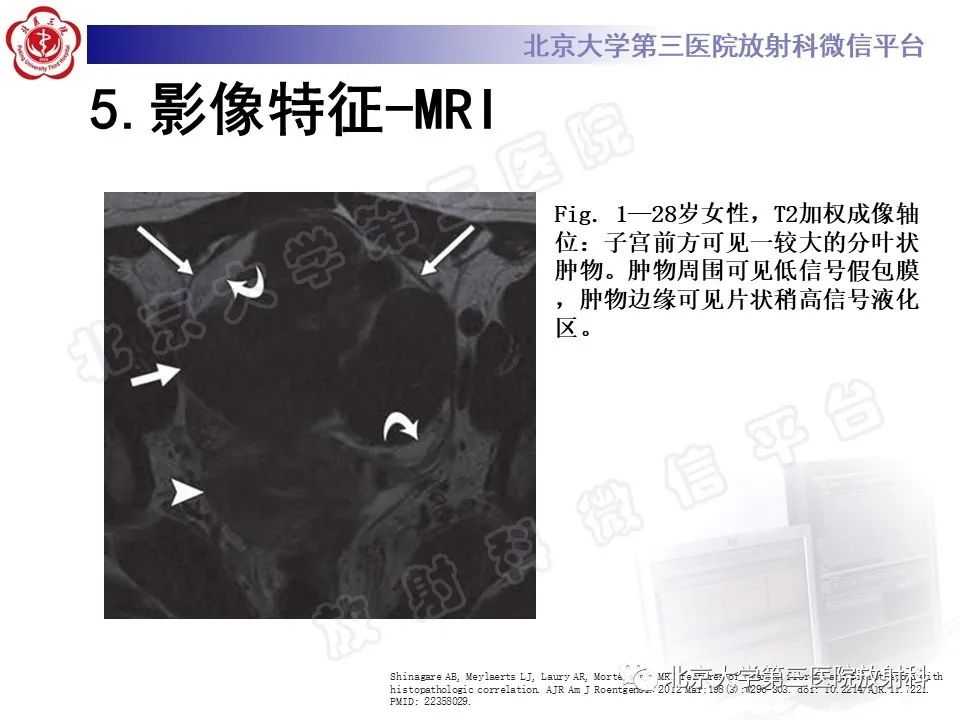 影像PPT - 【PPT】卵巢纤维卵泡膜细胞瘤-20