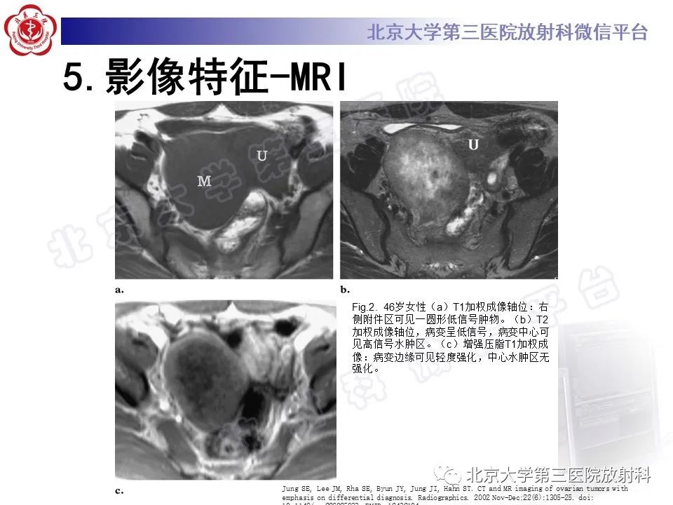 影像PPT - 【PPT】卵巢纤维卵泡膜细胞瘤-21
