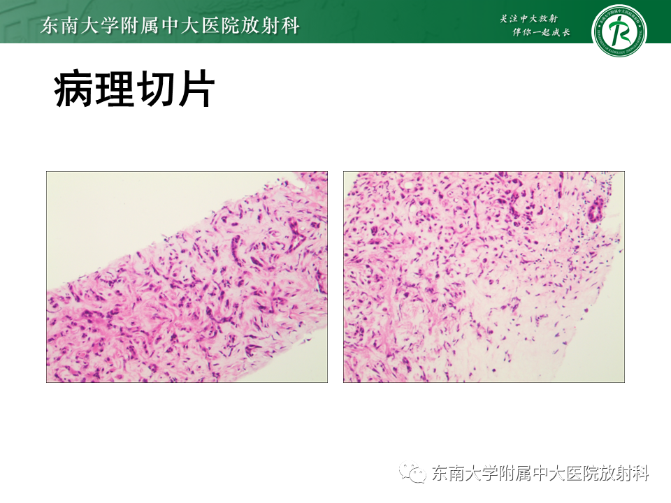 影像PPT - 【PPT】肝脏上皮样血管内皮瘤-4