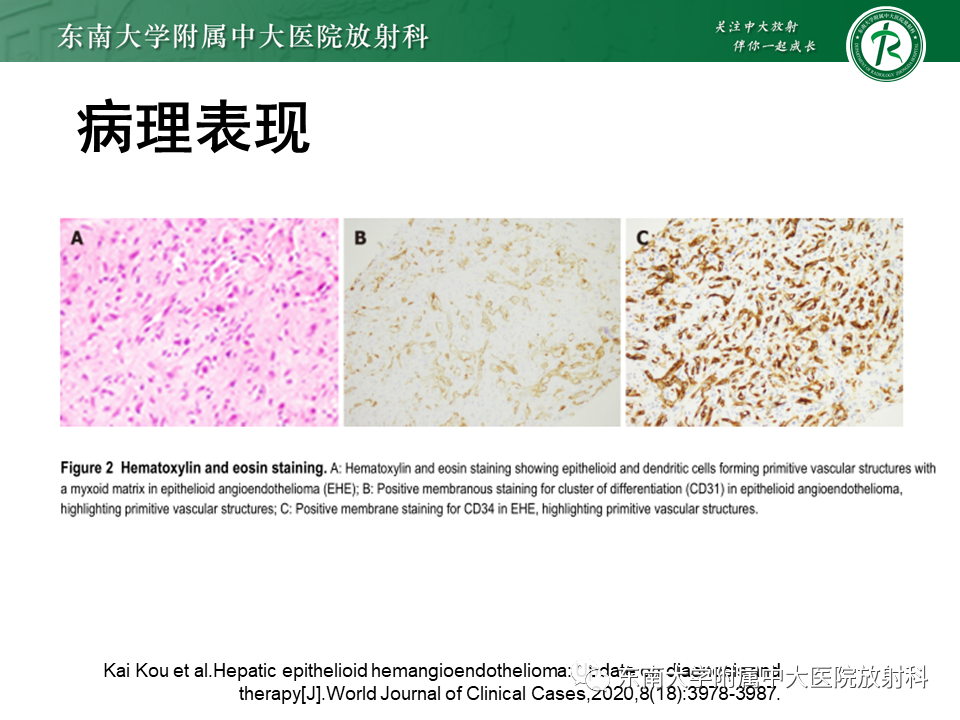 影像PPT - 【PPT】肝脏上皮样血管内皮瘤-9