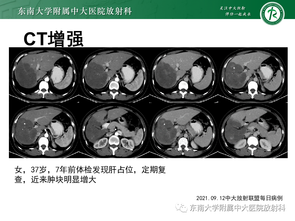 影像PPT - 【PPT】肝脏上皮样血管内皮瘤-13