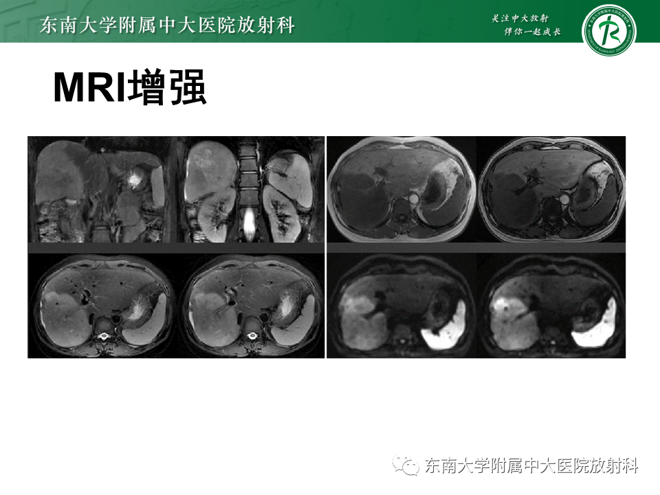 影像PPT - 【PPT】肝脏上皮样血管内皮瘤-14