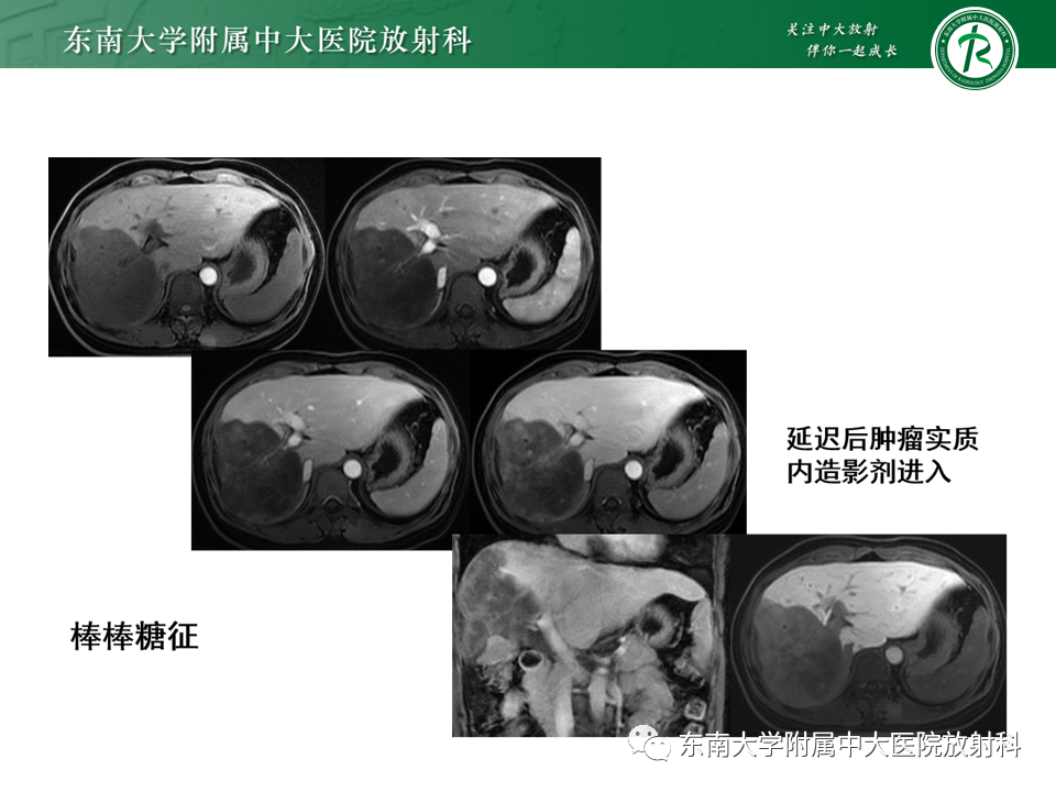 影像PPT - 【PPT】肝脏上皮样血管内皮瘤-15