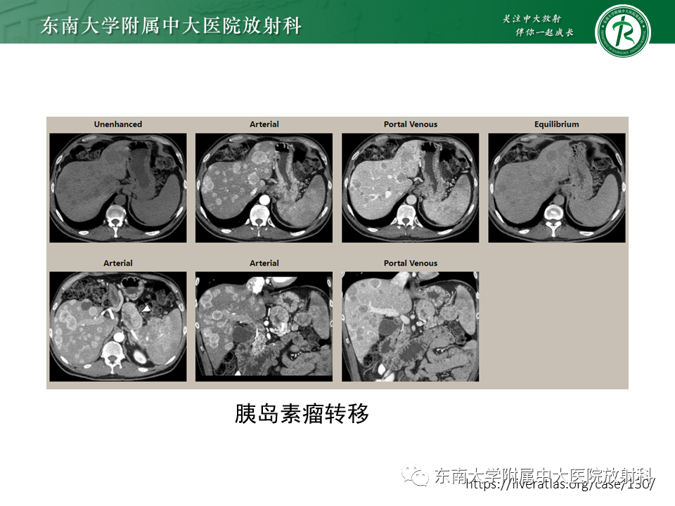 影像PPT - 【PPT】肝脏上皮样血管内皮瘤-19