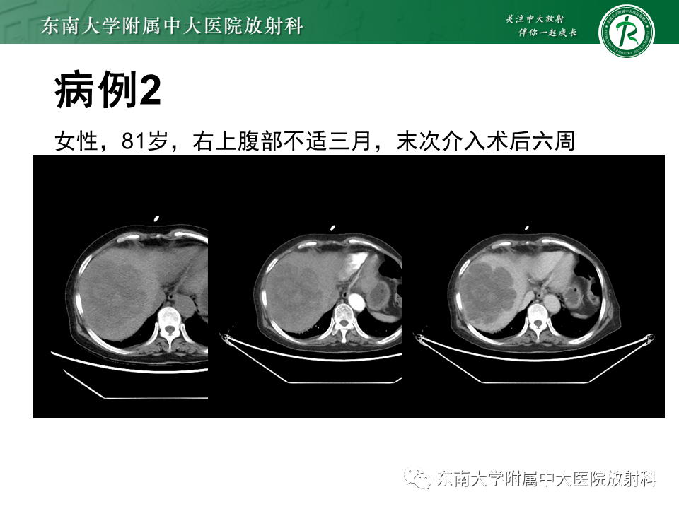 影像PPT - 【PPT】肝脏上皮样血管内皮瘤-21