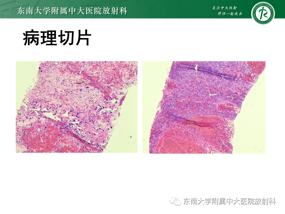 影像PPT - 【PPT】肝脏上皮样血管内皮瘤-23