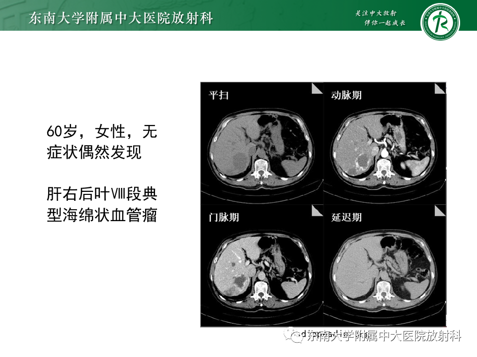 影像PPT - 【PPT】肝脏上皮样血管内皮瘤-25