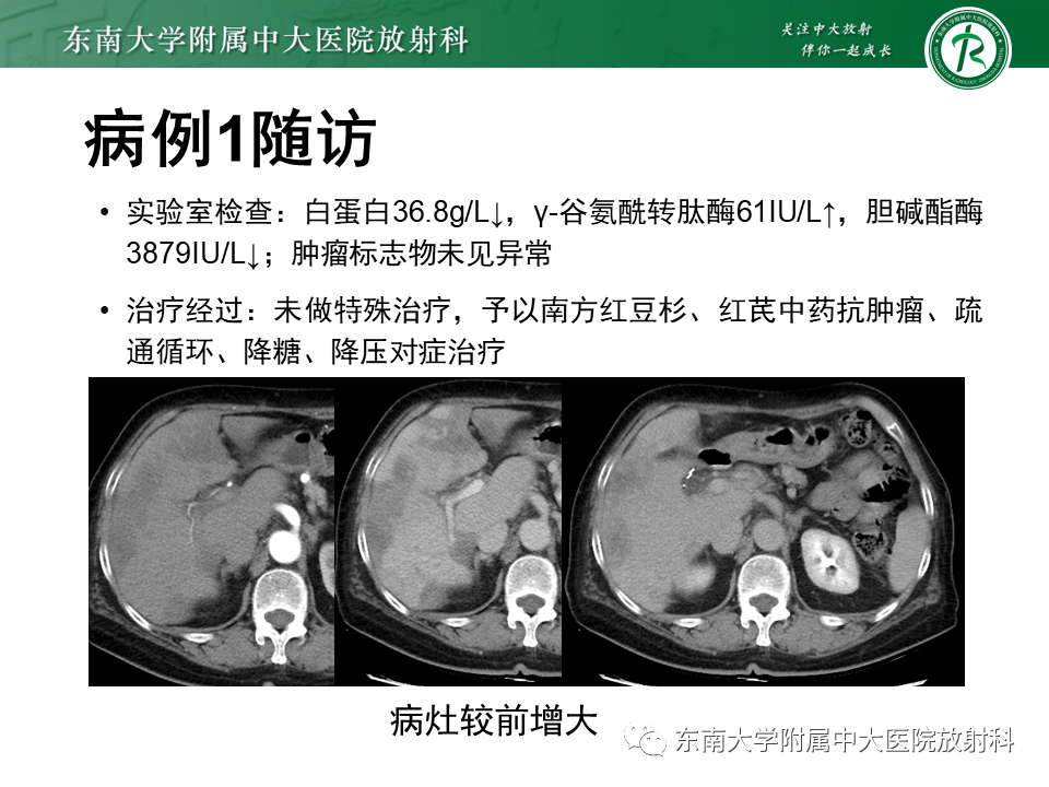 影像PPT - 【PPT】肝脏上皮样血管内皮瘤-30