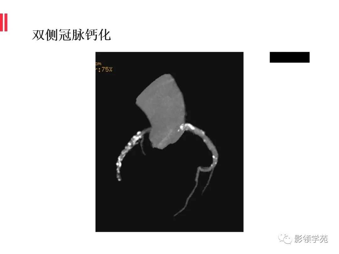 影像PPT - 【PPT】如何分析冠状动脉CTA-5