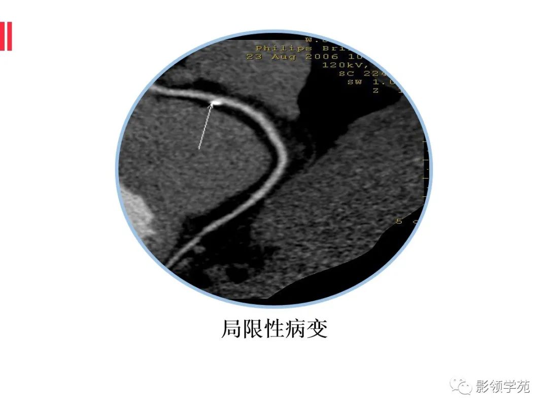 影像PPT - 【PPT】如何分析冠状动脉CTA-18