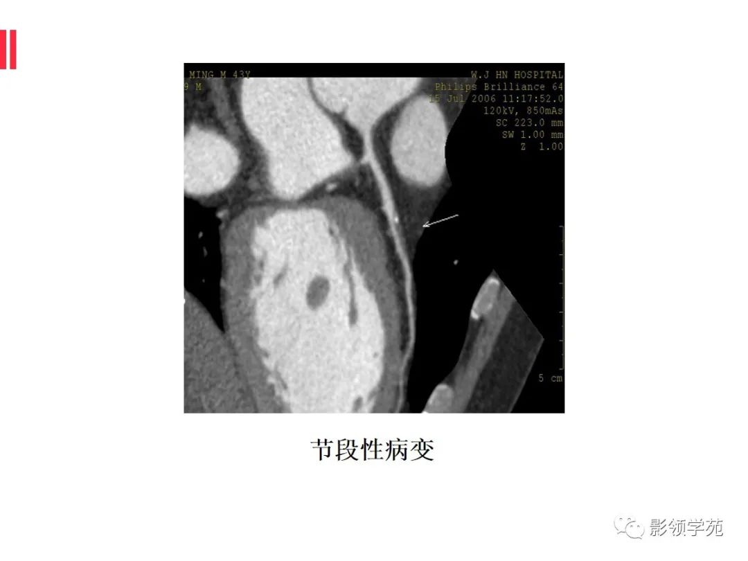 影像PPT - 【PPT】如何分析冠状动脉CTA-19