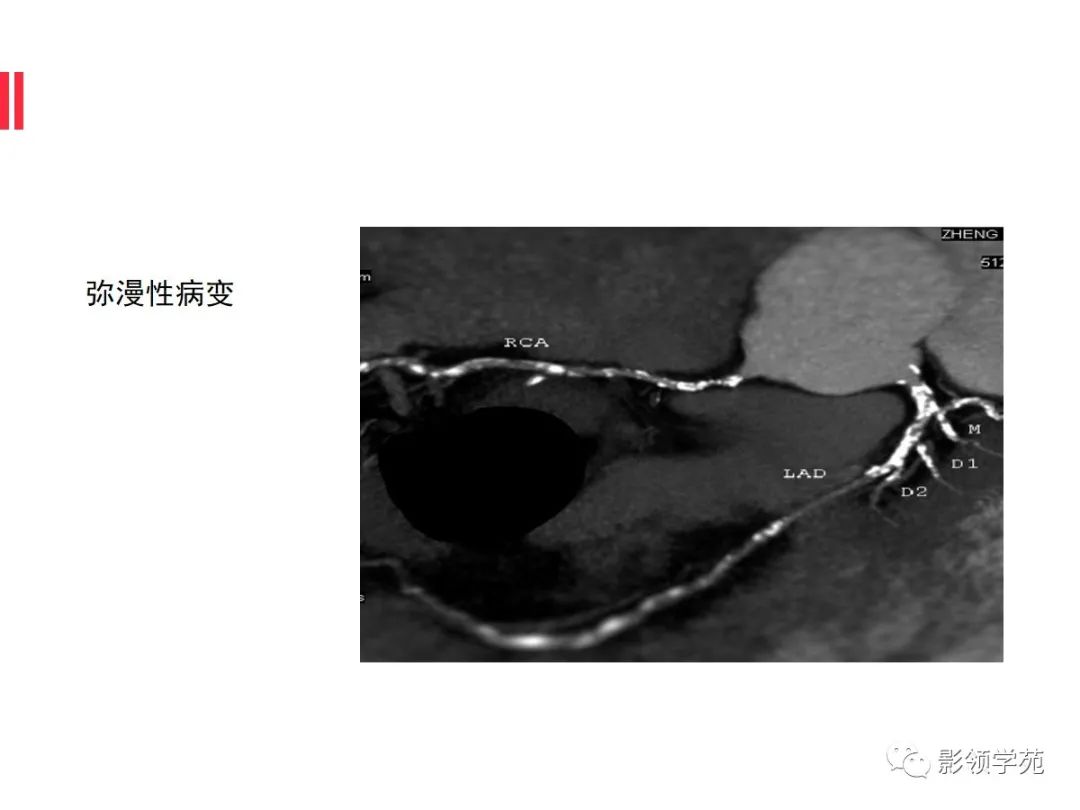 影像PPT - 【PPT】如何分析冠状动脉CTA-20