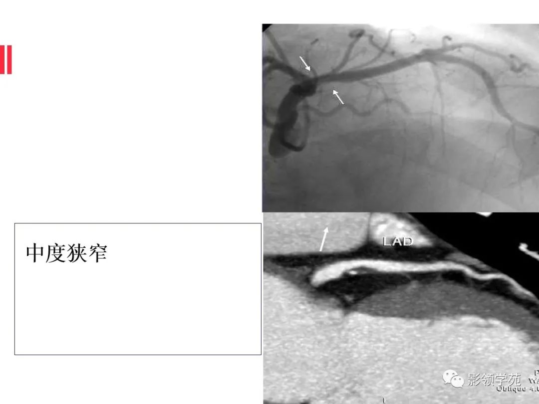 影像PPT - 【PPT】如何分析冠状动脉CTA-28