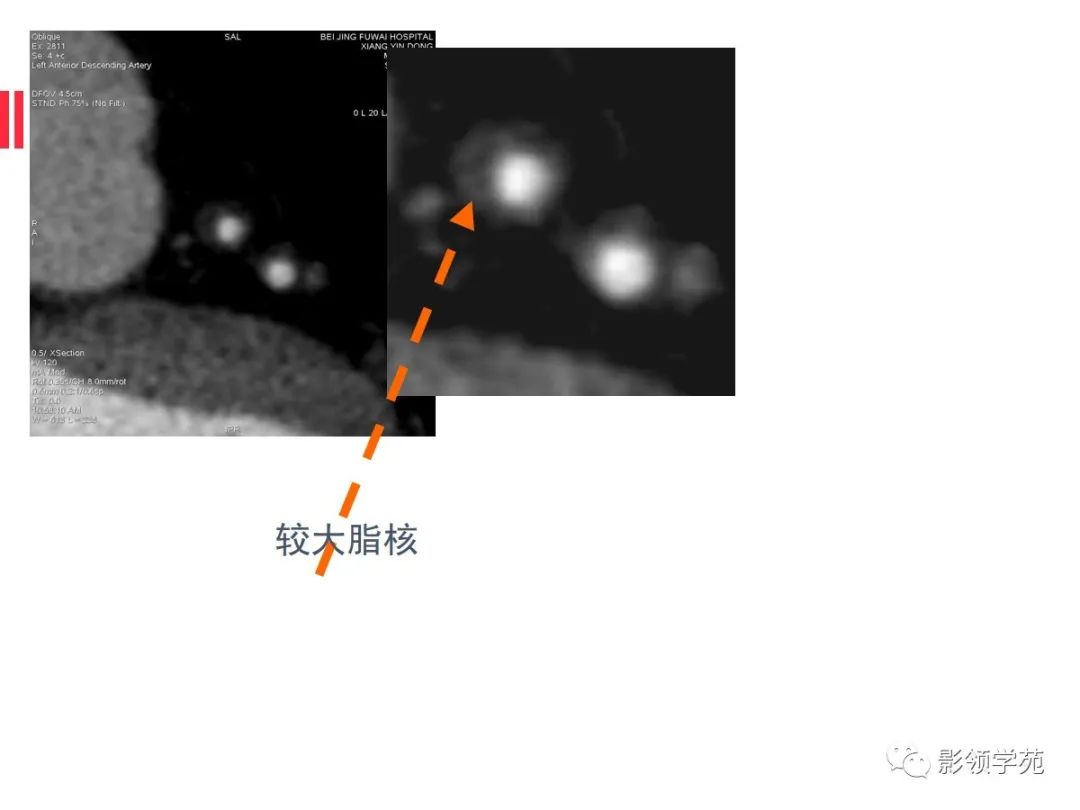 影像PPT - 【PPT】如何分析冠状动脉CTA-33