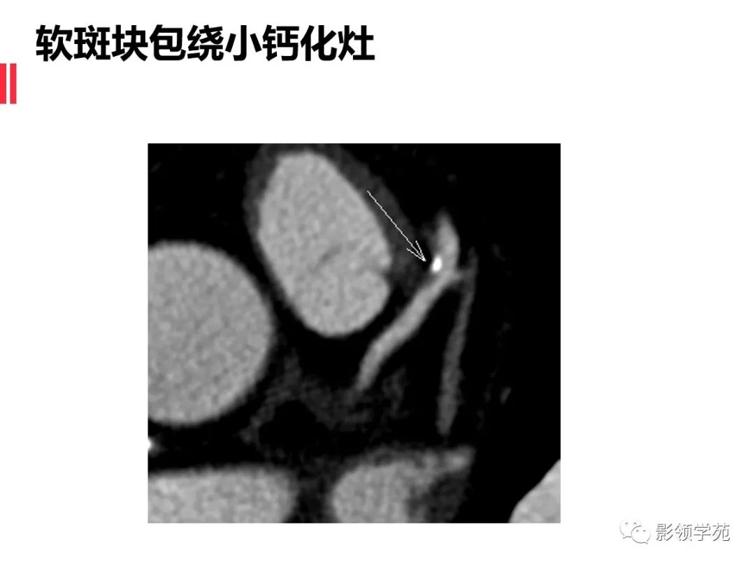 影像PPT - 【PPT】如何分析冠状动脉CTA-37