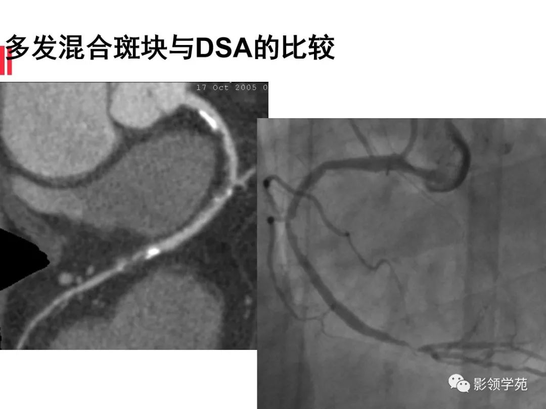 影像PPT - 【PPT】如何分析冠状动脉CTA-39