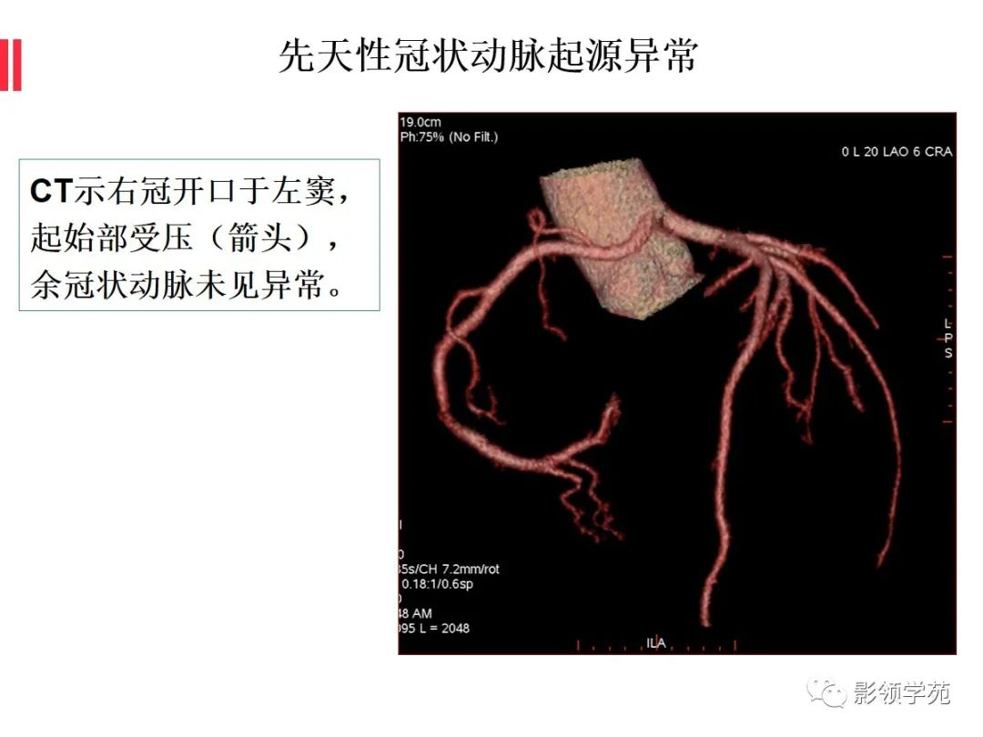 影像PPT - 【PPT】如何分析冠状动脉CTA-44