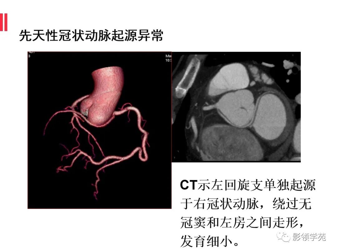 影像PPT - 【PPT】如何分析冠状动脉CTA-46