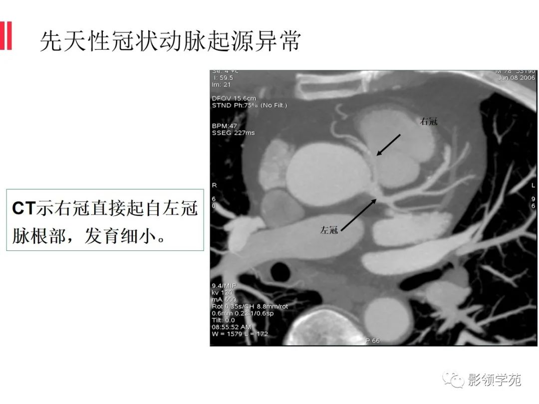 影像PPT - 【PPT】如何分析冠状动脉CTA-47