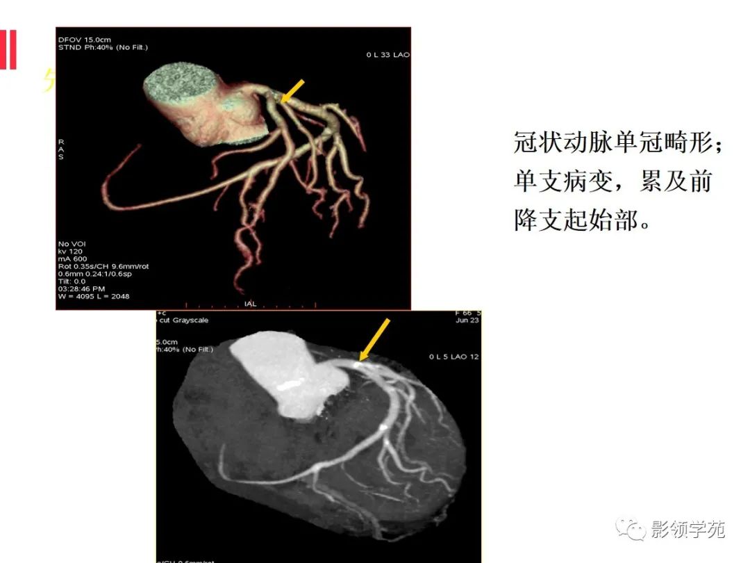 影像PPT - 【PPT】如何分析冠状动脉CTA-48