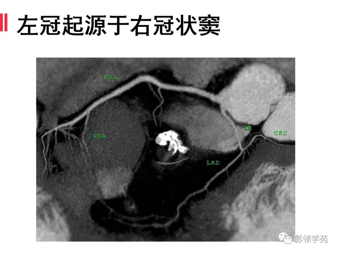 影像PPT - 【PPT】如何分析冠状动脉CTA-49