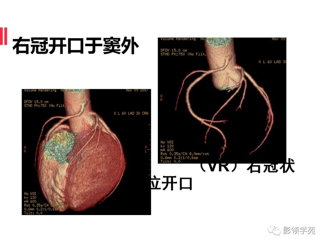 影像PPT - 【PPT】如何分析冠状动脉CTA-51