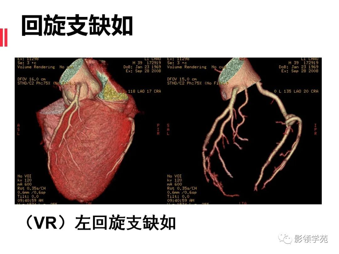 影像PPT - 【PPT】如何分析冠状动脉CTA-52