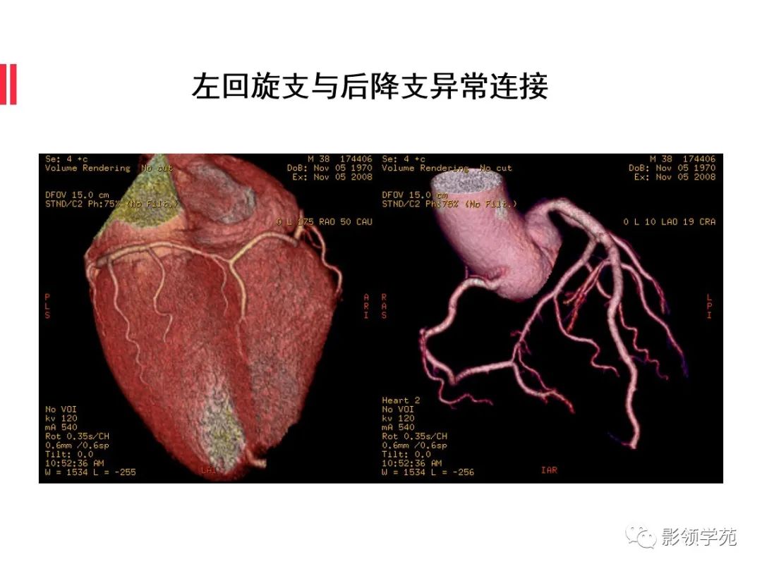 影像PPT - 【PPT】如何分析冠状动脉CTA-54