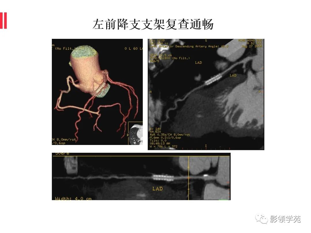 影像PPT - 【PPT】如何分析冠状动脉CTA-62