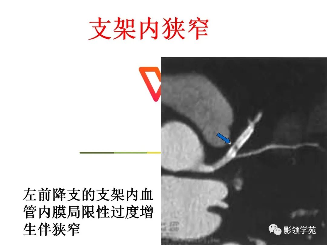 影像PPT - 【PPT】如何分析冠状动脉CTA-65