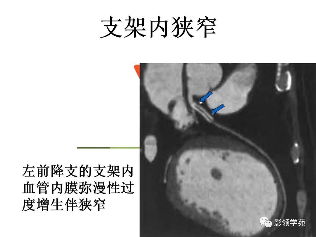 影像PPT - 【PPT】如何分析冠状动脉CTA-66
