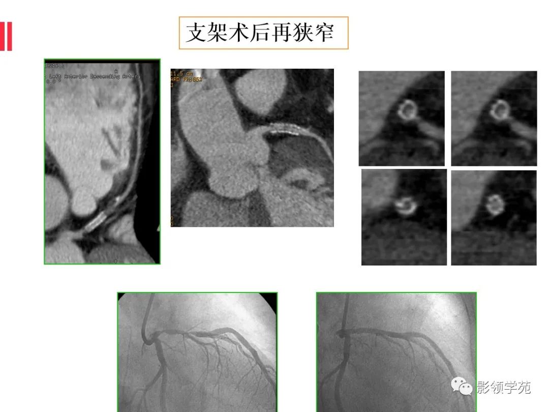 影像PPT - 【PPT】如何分析冠状动脉CTA-67