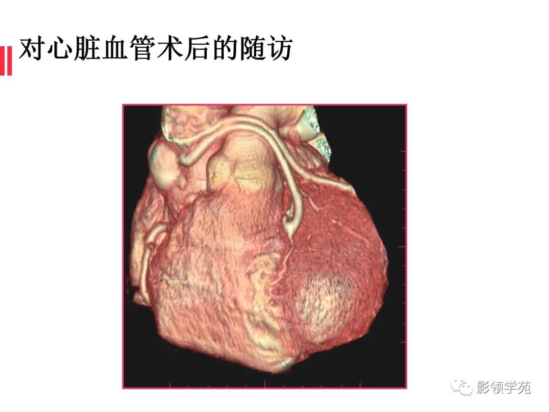 影像PPT - 【PPT】如何分析冠状动脉CTA-69