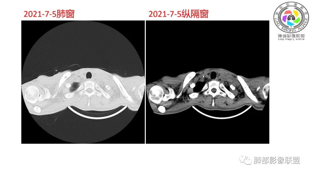 影像PPT - 【病例】马尔尼菲青霉菌病1例肺部CT影像-3 影像PPT - 【病例】马尔尼菲青霉菌病1例肺部CT影像-3