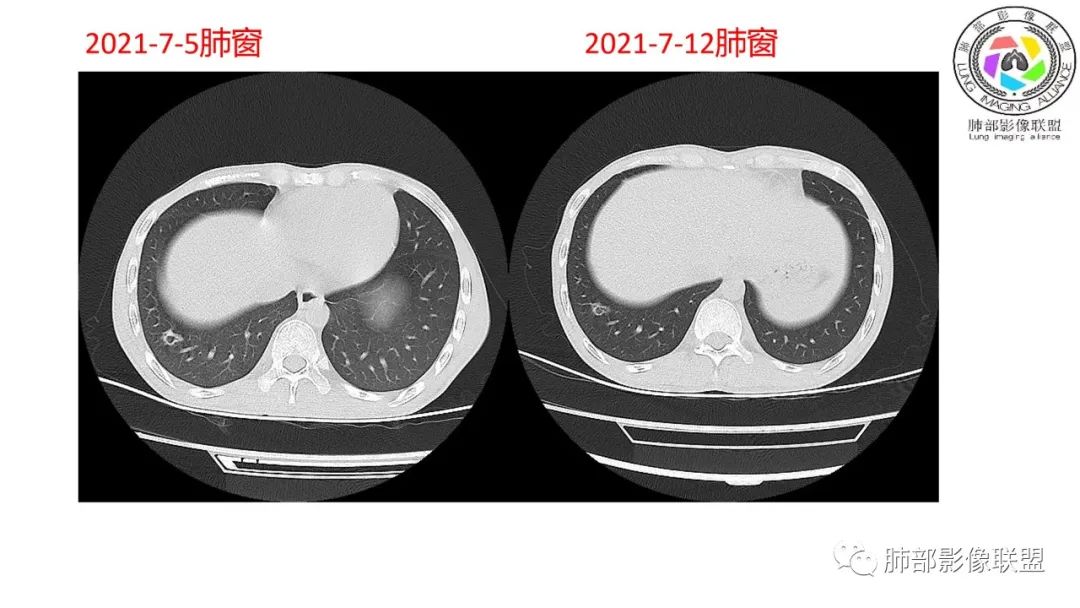 影像PPT - 【病例】马尔尼菲青霉菌病1例肺部CT影像-66 影像PPT - 【病例】马尔尼菲青霉菌病1例肺部CT影像-66